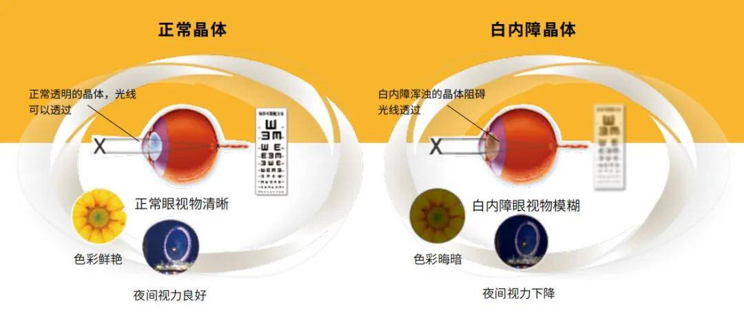 玻璃體混濁最新特效藥，突破與創(chuàng)新的治療策略
